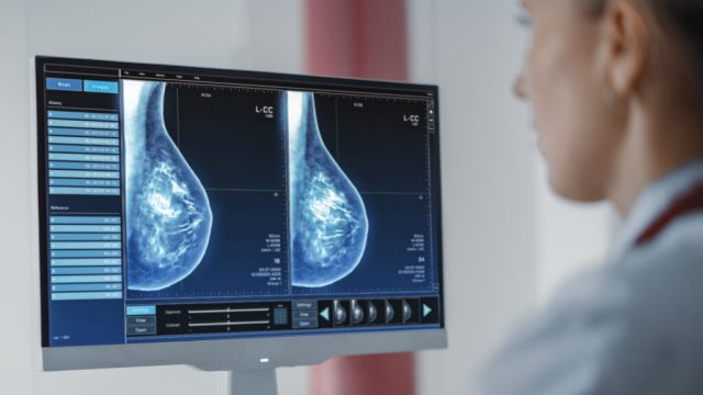 Artificial Intelligence(AI) Breast Cancer Model